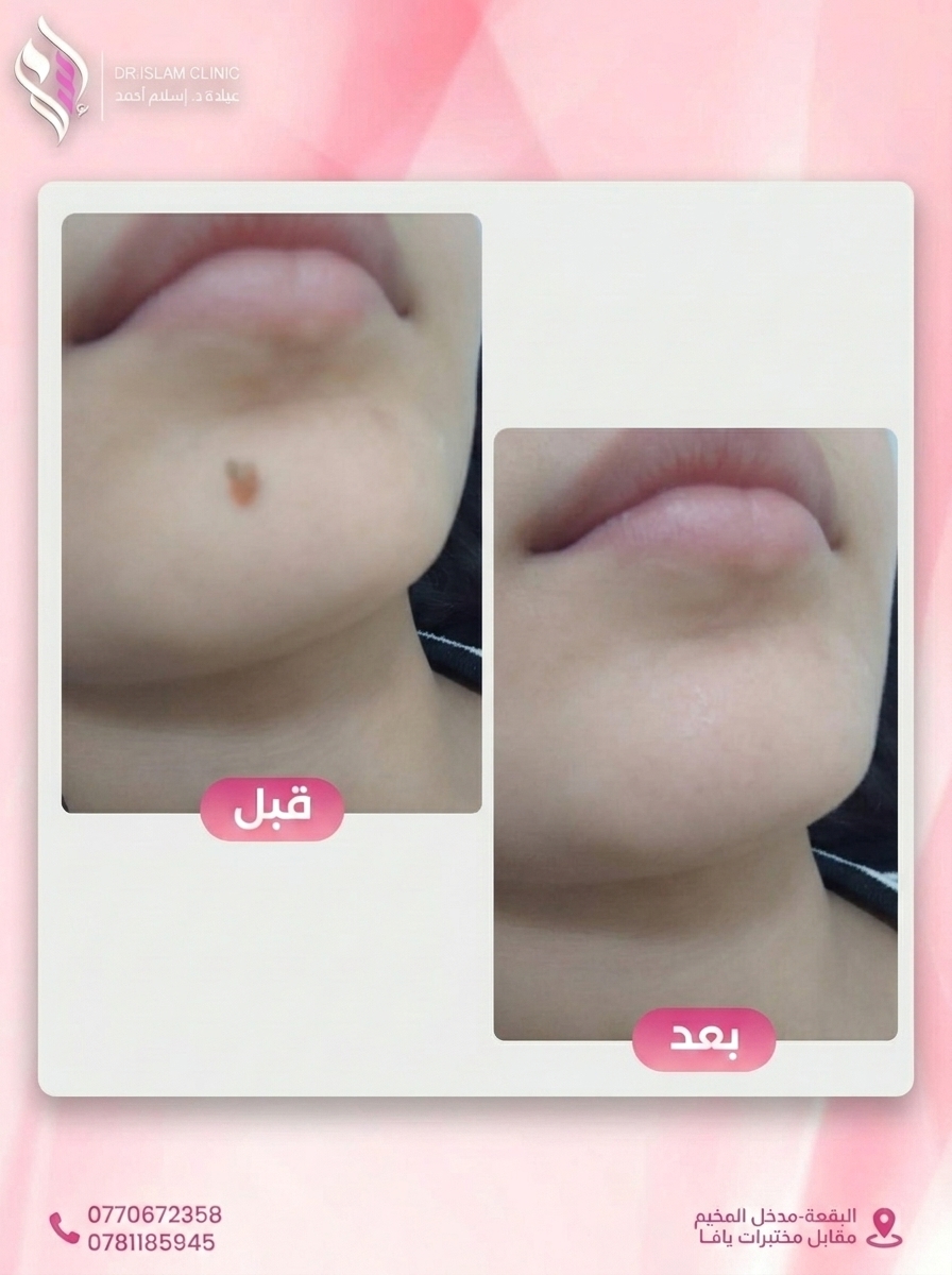 قبل وبعد 2
